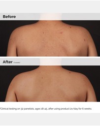 The Ordinary - Salicylic Acid 0.5% Body Serum