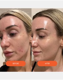 Kahlia Skin - LED Silicone Radiant Mask - Face, Neck & Décolletage