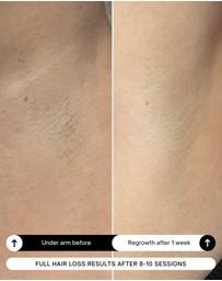 Happy Skin Co - Diamond IPL On The Go Bundle
