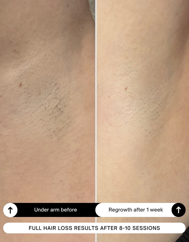 Happy Skin Co - Diamond IPL Hair Removal Handset