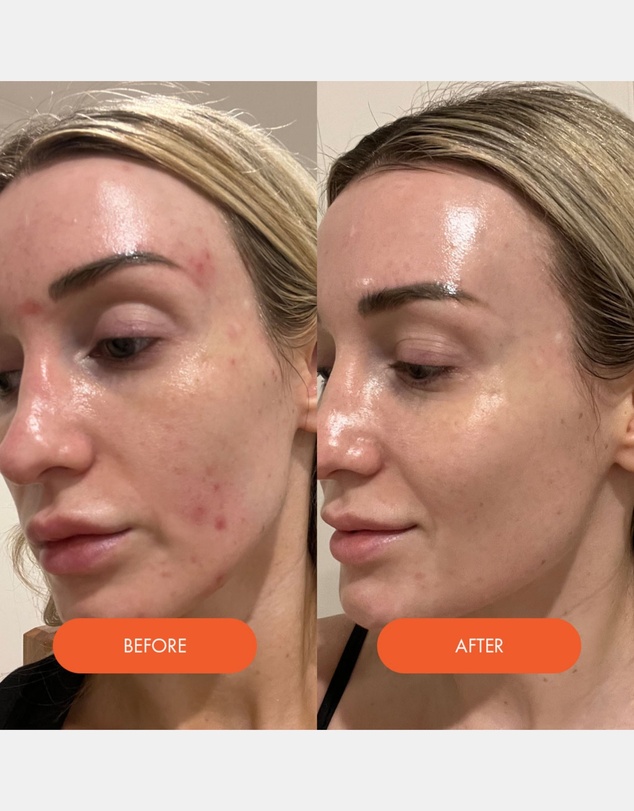 Kahlia Skin - LED Silicone Radiant Mask - Face, Neck & Décolletage