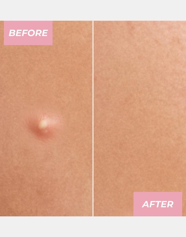 MCoBeauty - Miracle Pimple Patches