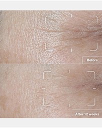 Clinique - Smart Clinical Repair SPF 15 Wrinkle Correcting Cream