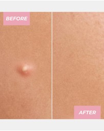 MCoBeauty - Miracle Pimple Patches
