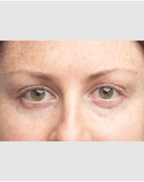 Clinique - All About Eyes Brightening Serum Concentrate