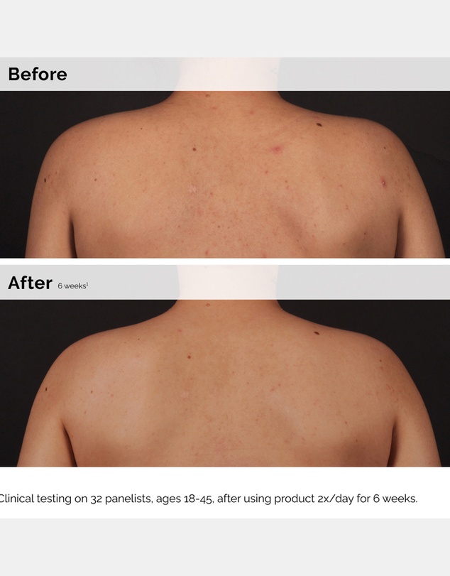 The Ordinary - Salicylic Acid 0.5% Body Serum