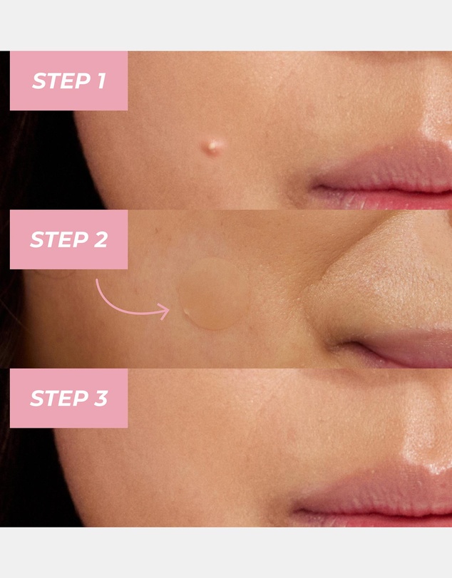 MCoBeauty - Miracle Pimple Patches